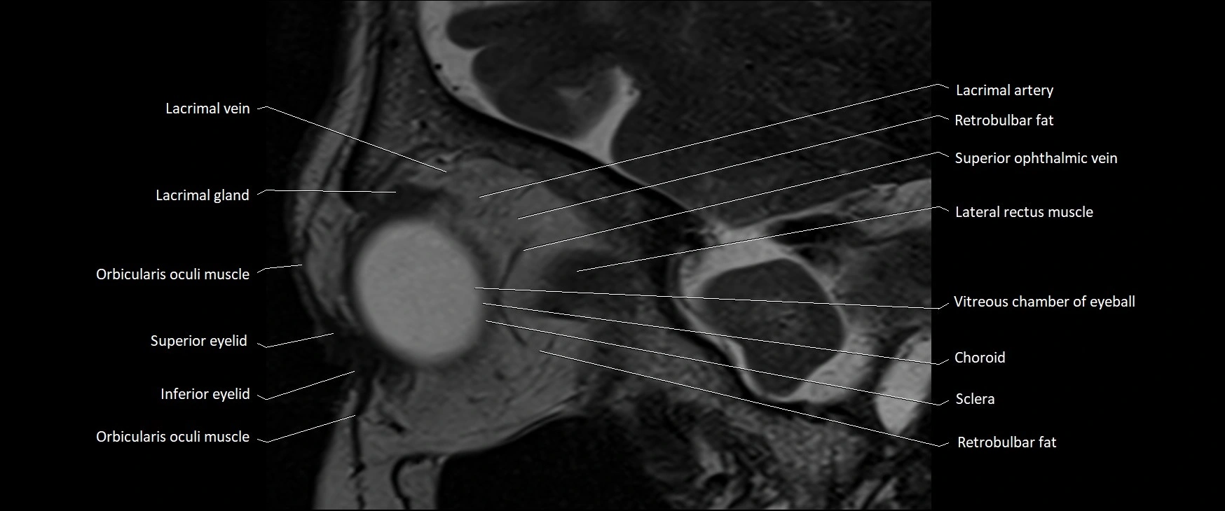 MRI Orbit sagittal cross sectional anatomy 3T image 14.webp